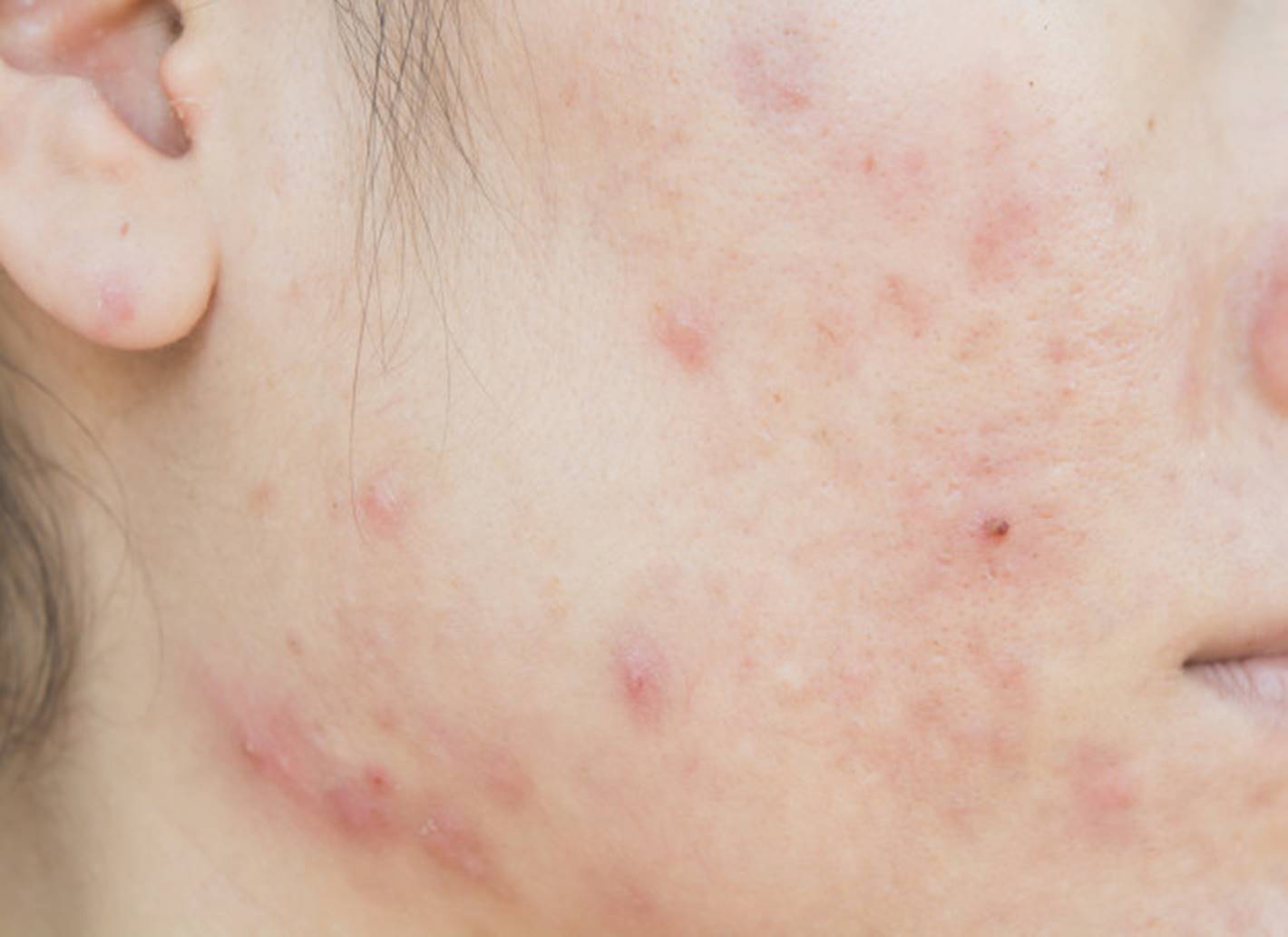 Elimine as acnes com estes dois ingredientes naturais