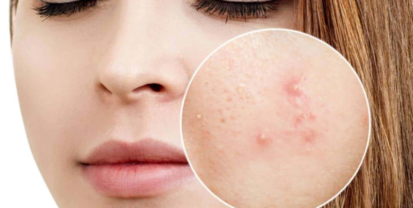 Como usar a farinha de trigo para combater a acne e ficar com a pele linda