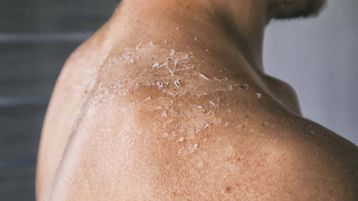 10 dicas para preparar sua pele para o sol do verão