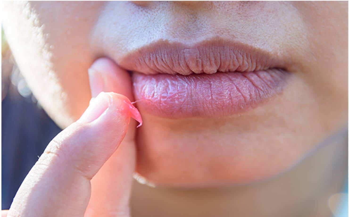 Elimine naturalmente as rugas dos lábios com remédios caseiros