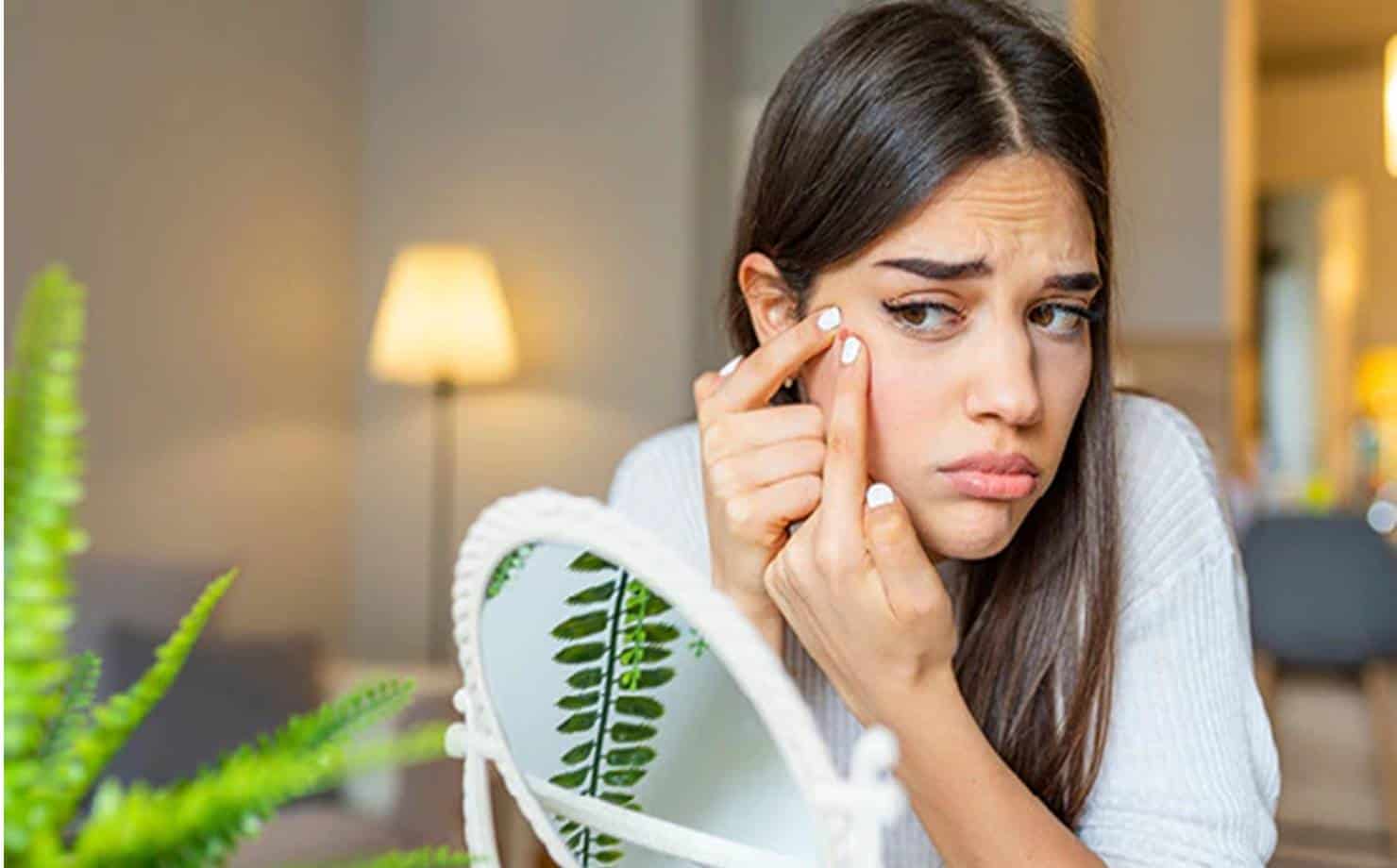 4 remédios caseiros para você se livrar das espinhas no rosto