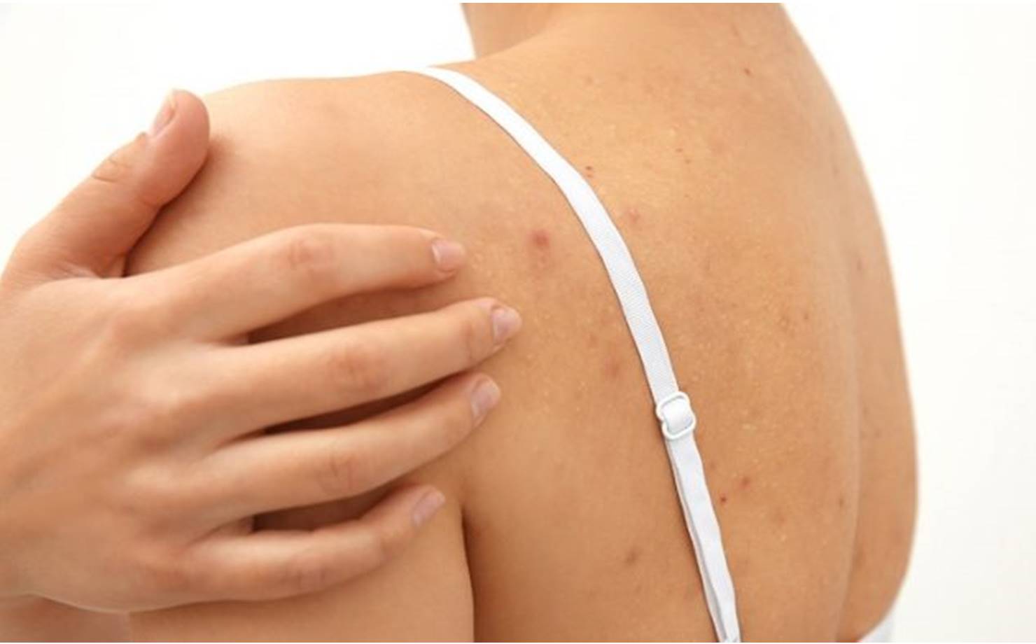3 maneiras de se livrar da acne nas costas com remédios 100% naturais